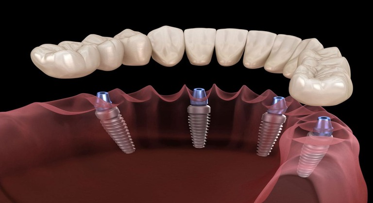 implant-ustu-protez