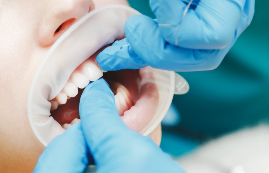 close-up-of-female-mouth-with-retractor-doctor-PWRQ6FA1